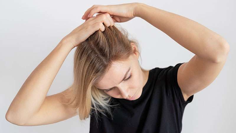 ¿Por que se produce la caspa y cuales son sus tratamientos?