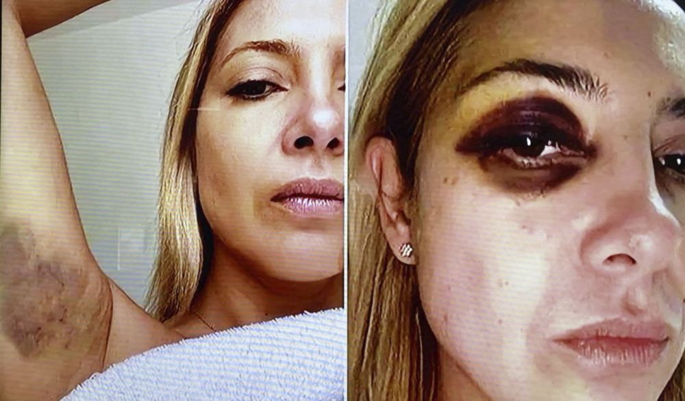 Filtran fotos de Fabiola Yañez con golpes tras la denuncia contra Alberto Fernández por violencia de género