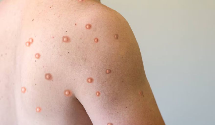 Confirman un caso de viruela del mono en La Plata y activan el protocolo sanitario